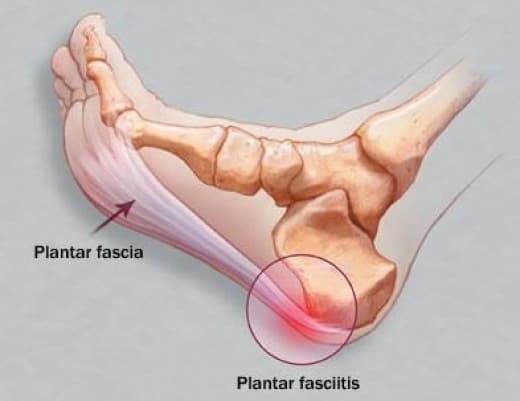 plantarni fasciitis bolečina v peti anatomija stopala