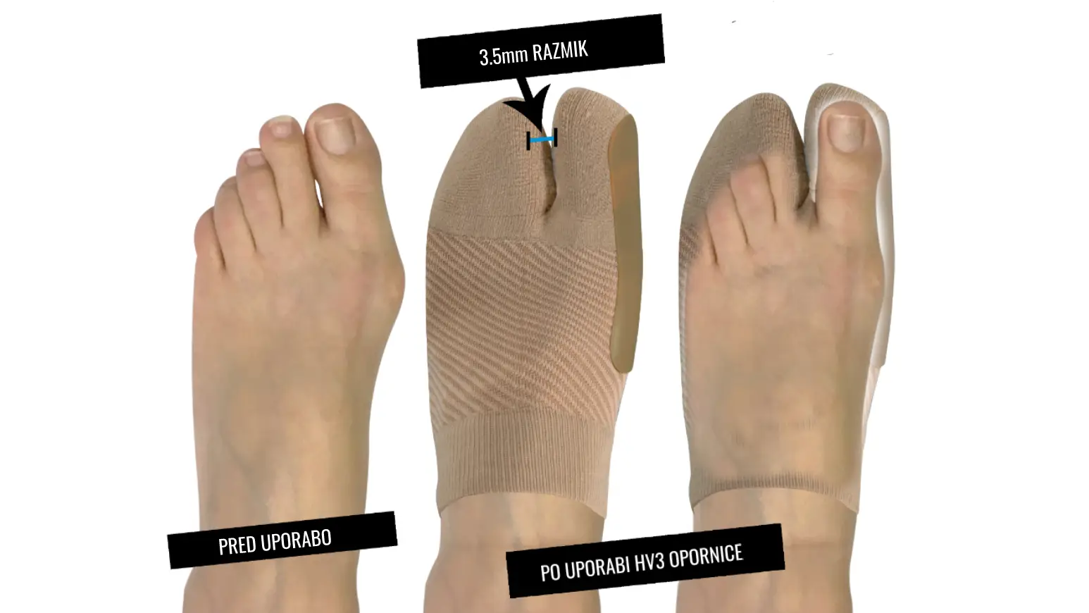 hallux valgus opornica HV3