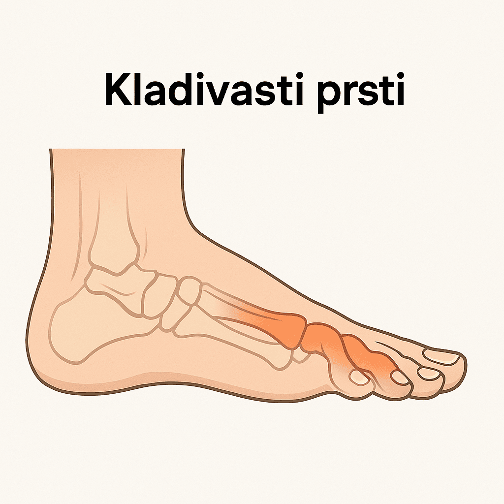 Kladivasti prsti