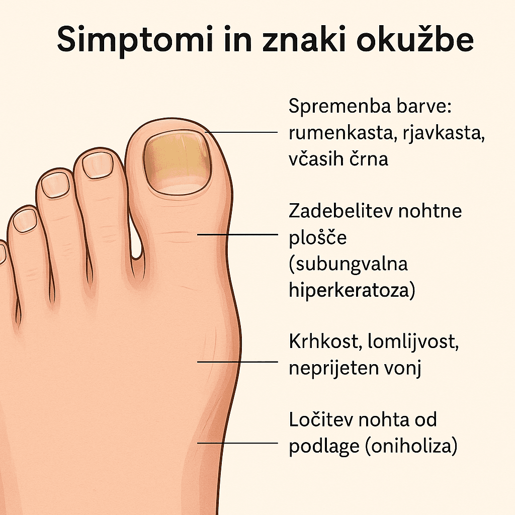 glivice na nohtih simptomi in znaki